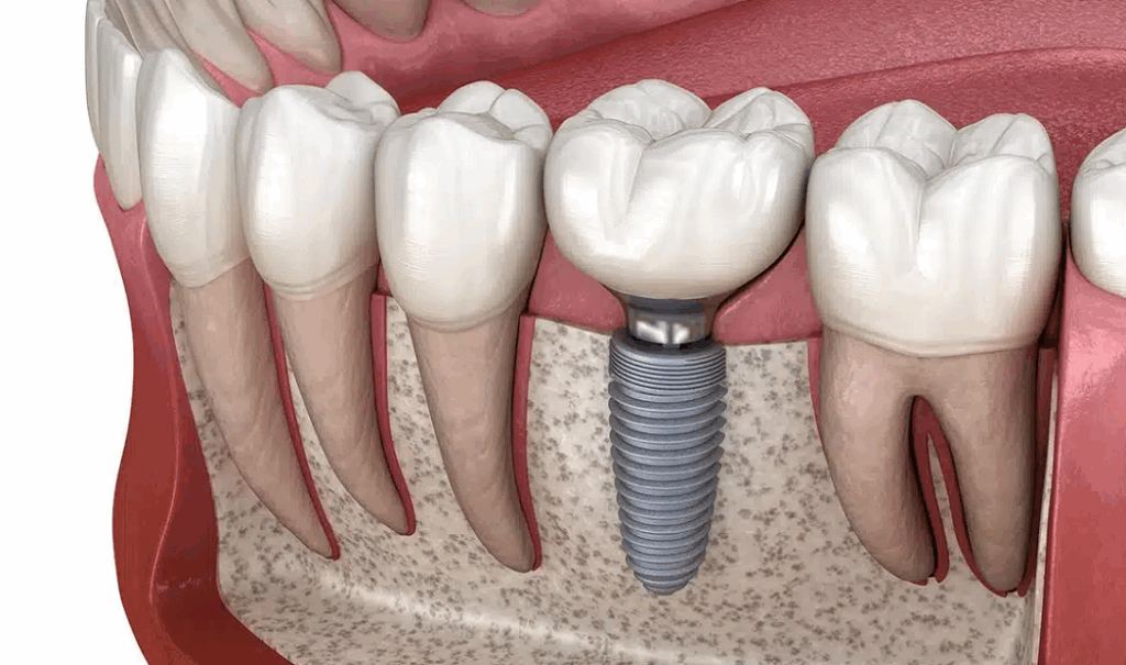 Dental Implants