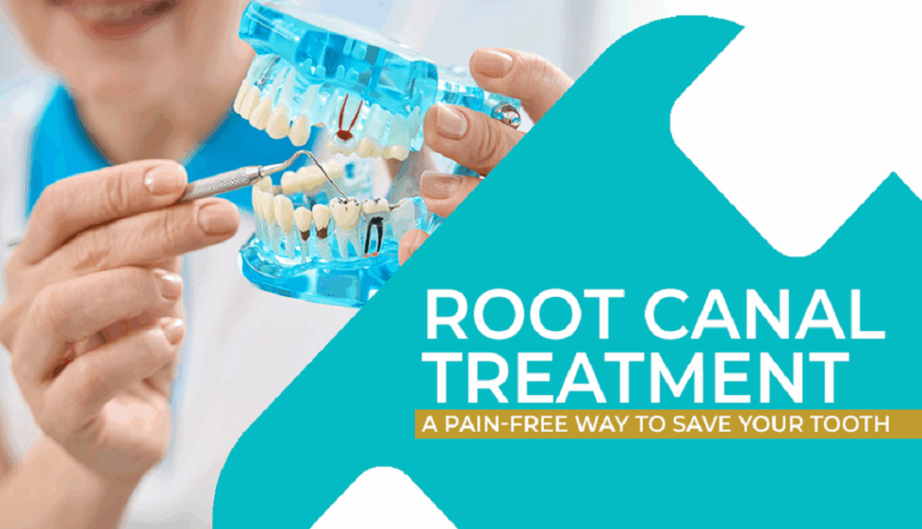 Root Canal Treatment