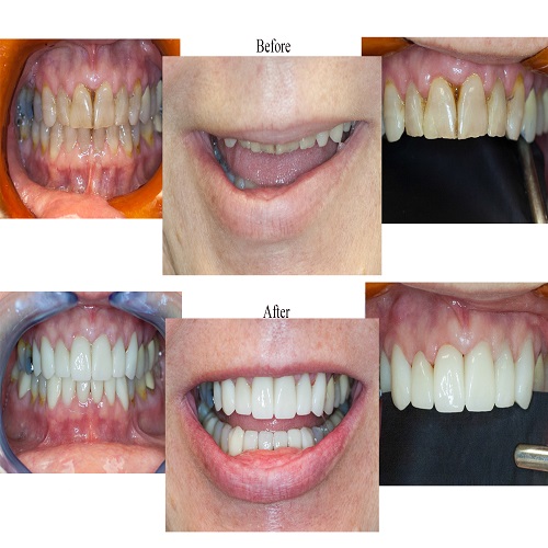 teeth treatments