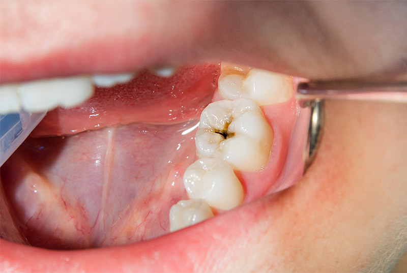 Dental Fillings Fairless Hills PA
