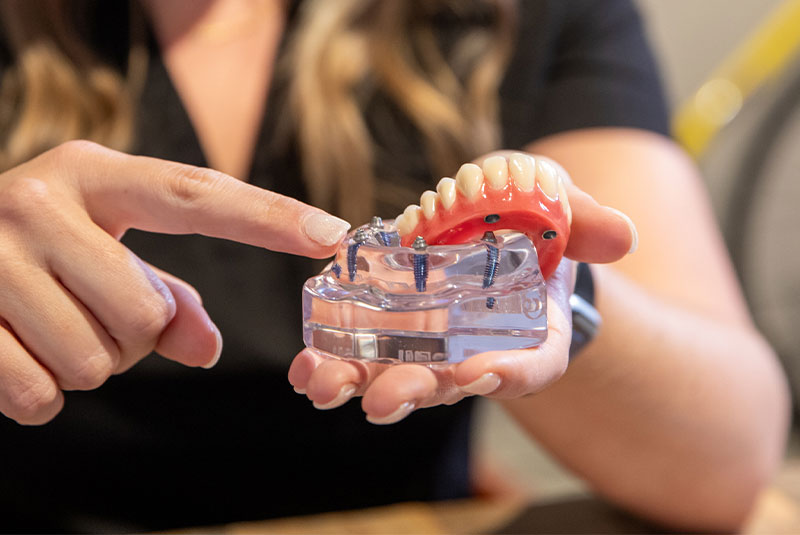 Full Mouth Dental Implants Fairless Hills PA