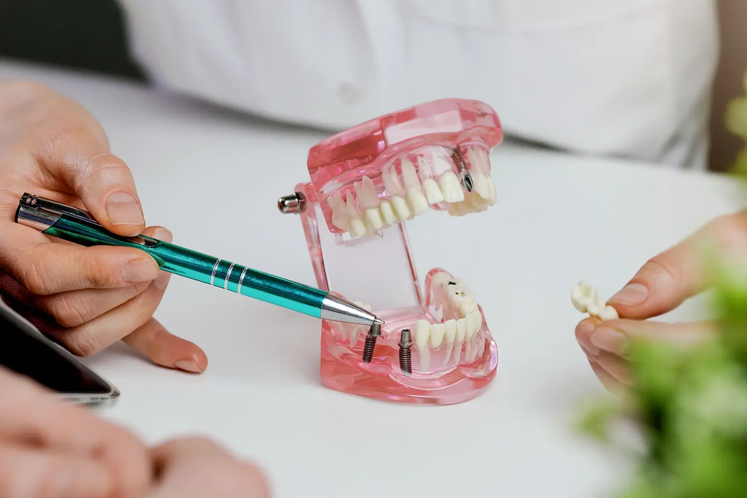 Multiple Dental Implants Fairless Hills PA