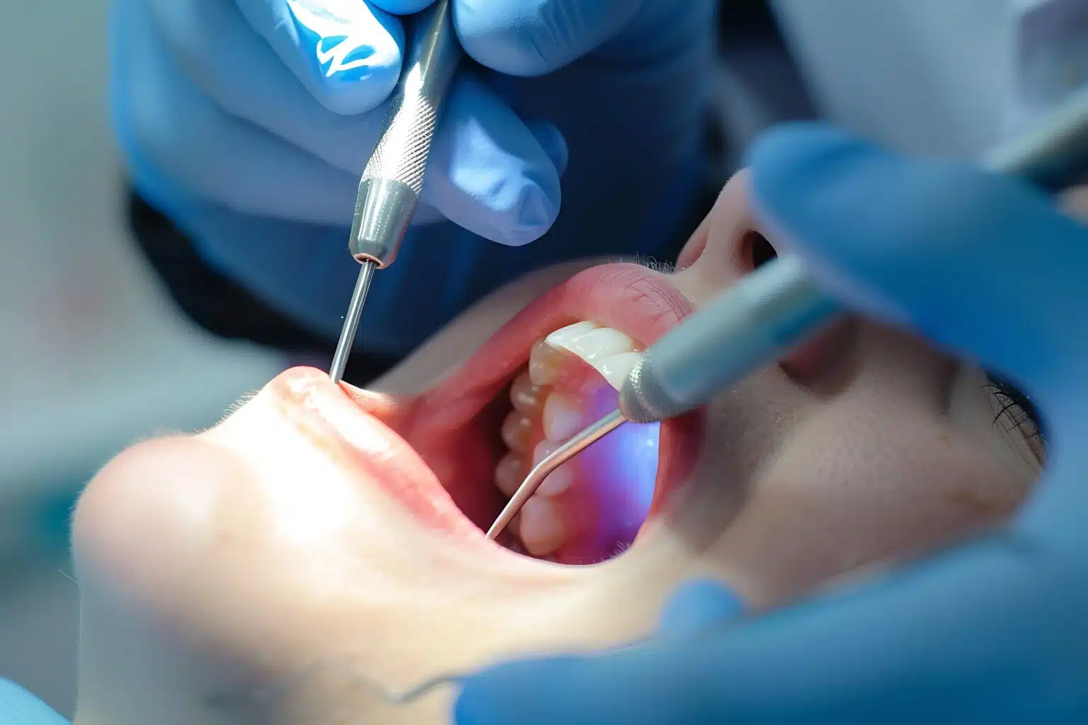 Root Canal Treatment Fairless Hills PA