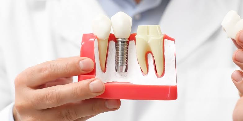 Single Tooth Implant Fairless Hills PA