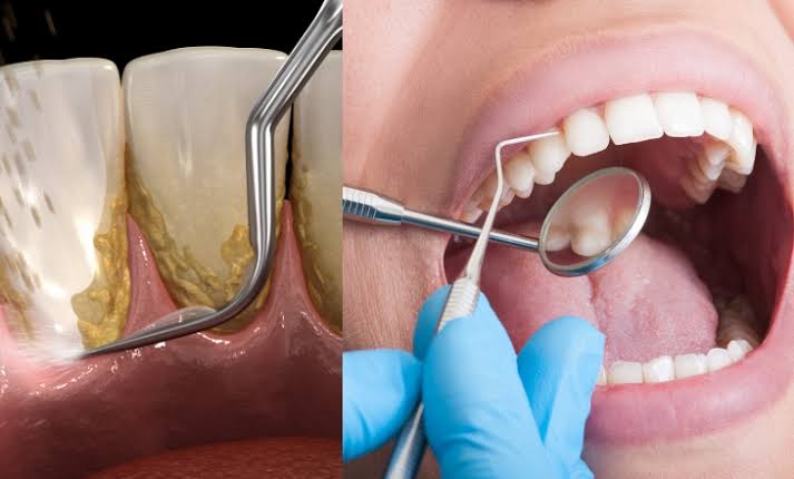 Teeth Cleaning in Fairless Hills PA